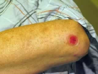 Abrasion on Elbow
