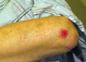 Abrasion on Elbow