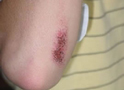 Abrasion on Elbow (3 Days Old)