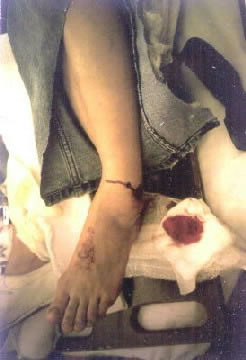 Ankle Fracture (Open)