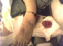 Ankle Fracture (Open)