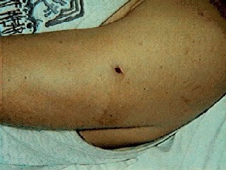 Puncture Wound - BB Gun