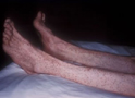 Rocky Mountain Spotted Fever