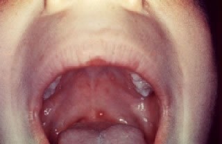 Chickenpox Sores in Mouth