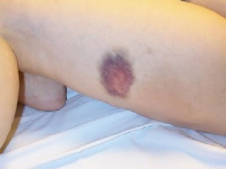Bruise on Thigh (1 Day Old)