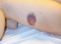 Bruise on Thigh (1 Day Old)