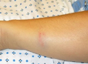 Bruise on Forearm
