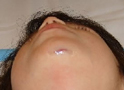 Laceration - Chin (After Skin Glue)