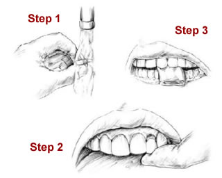 First Aid - Tooth - Knocked Out
