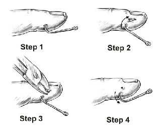 First Aid - Removing a Fishhook