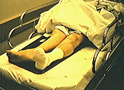 Hip Fracture
