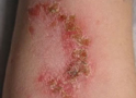 Impetigo of Elbow