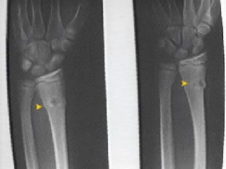 X-Ray - Torus Fracture of Wrist