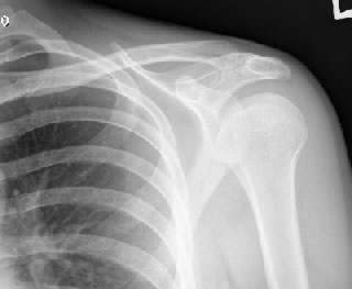 X-Ray - Normal Clavicle