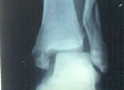 Radiografía de fractura de tobillo