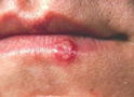 Herpes en el labio inferior
