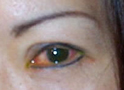 Conjuntivitis viral (ojo rosado)