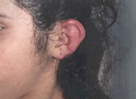 Congelación de la oreja