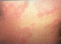 Urticaria en la espalda