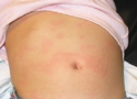 Urticaria en el abdomen