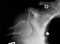 Radiografía: dislocación de hombro