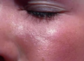 Lesión facial por quemadura de sol