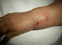 Infección de una herida - sitio de sutura