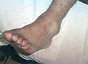 Ankle Sprain