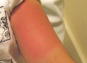 Bee Sting of Upper Arm