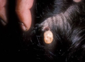 Wood Tick in Scalp