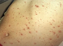 Chickenpox on Abdomen