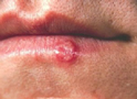 Cold Sore of Lower Lip