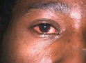 Conjunctivitis - Bacterial