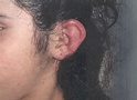 Frostbite of the Ear