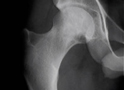X-Ray - Normal Hip
