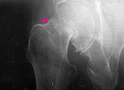 X-Ray - Hip Fracture