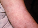 Penicillin Rash on the Arm