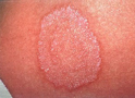 Ringworm Rash on Arm