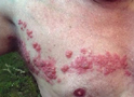 Shingles on Chest