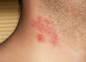 Shingles on Neck