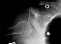 X-Ray - Shoulder Dislocation