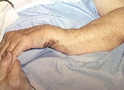 Wrist Fracture with Deformity