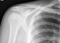 X-Ray - Normal Shoulder